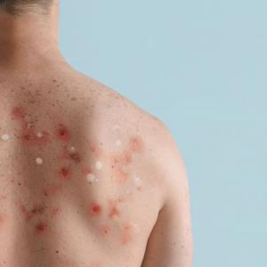 Fueron realizados los respectivos cercos epidemiológicos en estos círculos cercanos. 