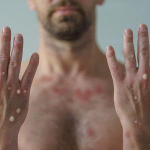 La persona está en aislamiento y se recupera sin complicaciones