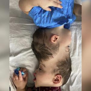 Los pequeños ya habían sido sometidos a nueve cirugías previamente