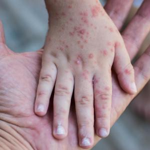 Las marcas en la piel es uno de los síntomas mas drásticos de la Viruela del Mono