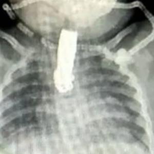 El cortaúñas se alojó en la garganta de la bebé y ahí quedó atorado. 