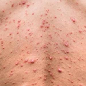 Uno de los síntomas de la viruela símica. 