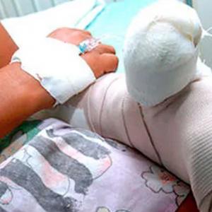 Imagen de referencia de un niño quemado con pólvora