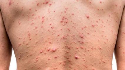 Uno de los síntomas de la viruela símica. 