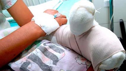 Imagen de referencia de un niño quemado con pólvora