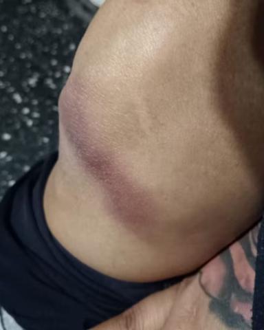 Pierna con hematoma de mujer que le cayó techo encima.